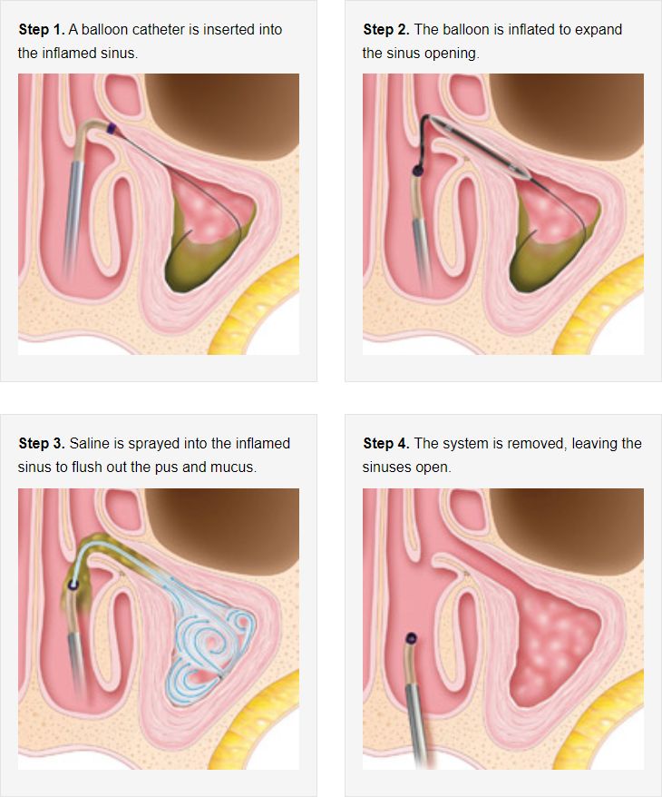 balloon sinuplasty in Singapore