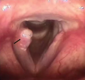 GERD-arytenoid-granuloma