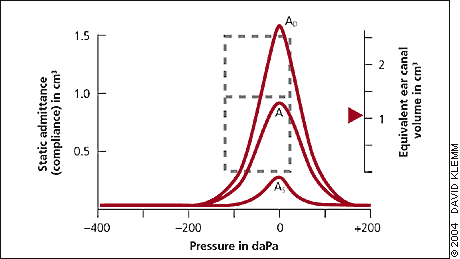tympanometry