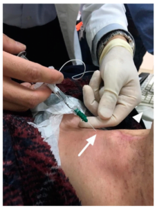 vocal cord injection