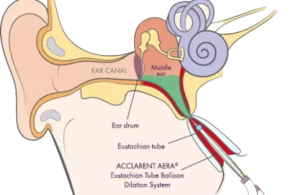eustachian tube balloon dilatation