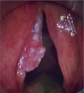 cancer-of-the-vocal-cord