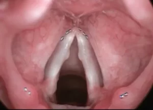 vocal cord nodules