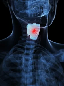 throat cancer