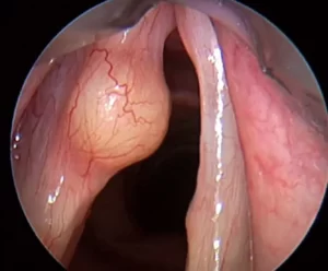 vocal cord cyst