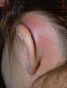 mastoiditis