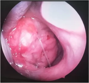 Nasopharyngeal Cancer (NPC)