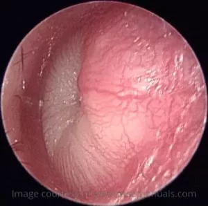 otitis media
