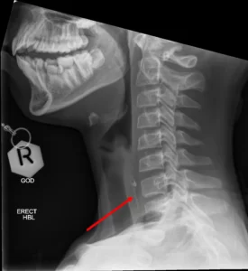 swallowed-chicken-bone